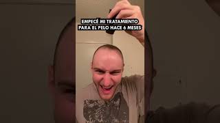 Hace 6 Meses Empecé El Tratamiento Para Mi Alopecia [upl. by Rahs]