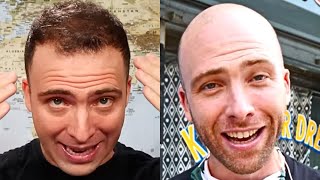 BIG YouTubers Who Went BALD [upl. by Sasha650]