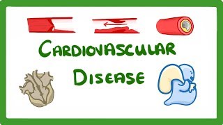 GCSE Biology  Why Do We Get Heart Disease and How to Treat It  Cardiovascular Disease CVD 47 [upl. by Notsahc]