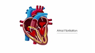 What is atrial fibrillation [upl. by Yajet]