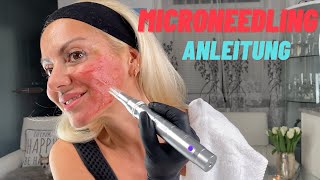 MICRONEEDLING ANLEITUNG  Wirkt es wirklich  Selbsttest [upl. by Ecart]