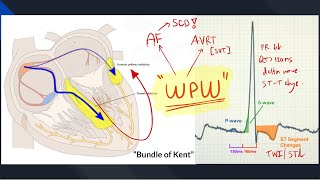 WolffParkinsonWhite WPW Syndrome  A practical review for Med student amp GPs [upl. by Codi]