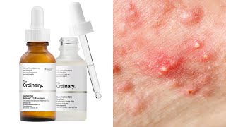 Acne in Dry Skin  what to use  serums creams  Dermatologist recommends [upl. by Arad345]