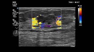 invasive ductal carcinoma [upl. by Attenreb]