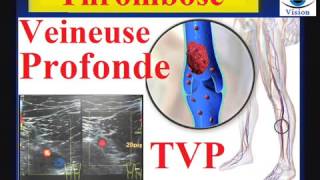 Thrombose veineuse profonde symptômes traitement recommandations Prévention de lembolie pulmonaire [upl. by Fredi]