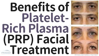 Benefits of PlateletRich Plasma PRP Facial Treatment and Why the Vampire Facelift® is Different [upl. by Schild879]