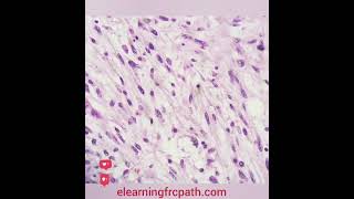 softtissue spindlecell liposarcoma dedifferentiated frcpathpart2 elearningfrcpathcom [upl. by Whale189]