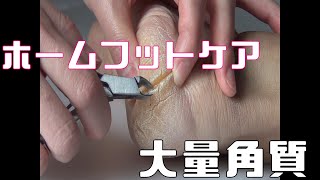 【大量角質】成長かかと削ります。How to remove cracked heel at home Japanese wife how to treat there husband [upl. by Johannes]