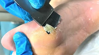 Callus removal from feetampFoot scraping dead skin【Xiao Yan pedicure】stress 703 [upl. by Anoynek]