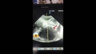 Left Atrium Enlargement 😱 clinicalmedicine cardiology drkmc [upl. by Eido]