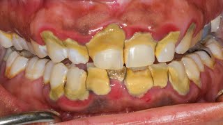 15 Years Without Brushing Teeth  Calculus Buildup [upl. by Sanyu]