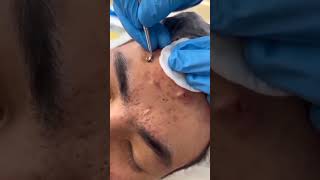 Blackhead Removal On Forehead oddlysatisfying sick blackhead pimplepopper satisfying acne [upl. by Llerdnad]