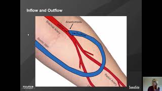 Webinar Dialysis Vascular Access Flow Volume [upl. by Haraz752]