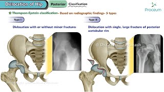 Dislocation Of Hip Orthopedics Lecture [upl. by Toms]