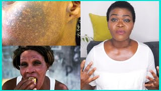 HOW TO REPAIR DAMAGED BLEACHED SKIN  What To Use After Skin Bleaching To Make Your Skin Glow [upl. by Notnelc849]