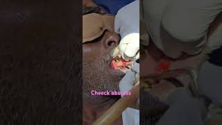 Cheeck abscess  drainage  i and d drainage of abscess  Dr Hitesh Patel [upl. by Blackwell92]