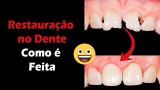 Como é Feita e Qual o Preço de uma Restauração de Dente Cariado  Resina Composta [upl. by Ydorb]