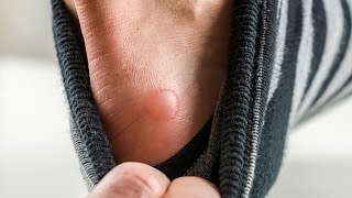 The Basics Should You Pop a Blister [upl. by Faus]