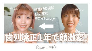 【歯列矯正】ついに１年経過！歯並び・顔の変化・矯正中のホワイトニング事情【表側ワイヤー矯正】 [upl. by Enid481]