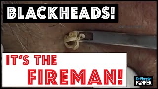 Dont miss these huge blackhead extractions in quotThe Firemanquot [upl. by Yruama]