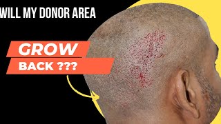 Donor Area Recovery After Hair Transplant  Fue Donor Area In Hair Transplant [upl. by Light]