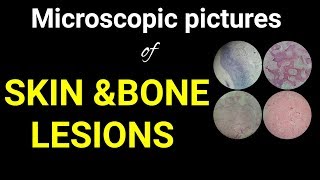 Oral pathologyMicroscopic histology pictures of boneamp skin lesions in oral region Dr Poojireddy [upl. by Prima]