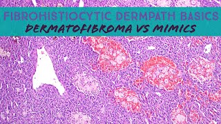 Fibrohistiocytic Dermpath Basics  dermatofibroma amp mimics dermatology dermatopathology pathology [upl. by Dabbs551]