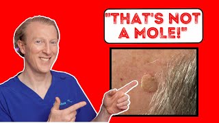 Thats not a mole Uncovering the Mystery of Seborrheic Keratosis [upl. by Nnaeinahpets]