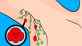 How to Ease Swollen Lymph Nodes in the Armpit [upl. by Norvun]