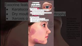 Sjogren syndrome [upl. by Noteek]