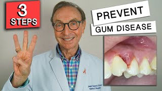 3 Easy Ways to Prevent Gum Disease at Home [upl. by Cornel756]