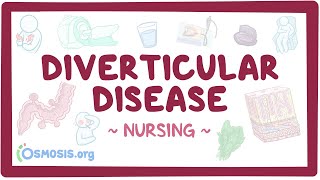 Diverticular disease Clinical Nursing Care [upl. by Audras]