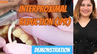 HowTo Perform Interproximal Reduction IPR for Orthodontic Treatment  a clinical demonstration [upl. by Salta]