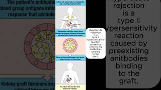 Hyperacute rejection is a type 2 hypersensitivity reaction caused by preexisting antibodies [upl. by Sregor576]