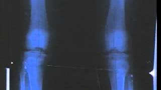 Leg Surgery Femoral Lengthening Over Nail [upl. by Bergin]