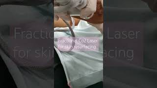 Fractional Co2 laser Treatment [upl. by Naihtsirc591]