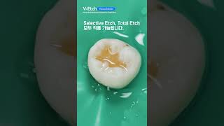 V Etch total etch dentist etch Selective etch [upl. by Adnorehs]