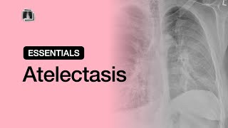 Atelectasis  Chest Radiology Essentials [upl. by Lehcem821]