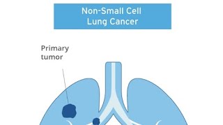 Contraindications to Lung Cancer Surgery NonSmall Cell Lung Cancer  Dr Wasim [upl. by Onaireves]