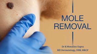 Compound mole removal [upl. by Esaertal]