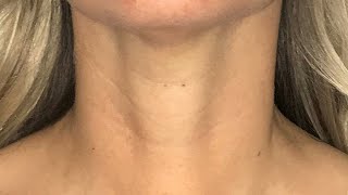 Scarless Thyroidectomy  Transoral Endoscopic Thyroidectomy Vestibular Approach [upl. by Darrelle]