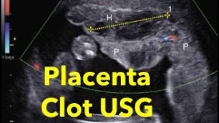 Placental clot and placental lakes ultrasound  color doppler [upl. by Ynttirb]