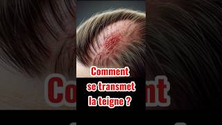 Comment se transmet la teigne  teigne prendresoindesoi bienetre [upl. by Aicenav]