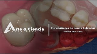 ►Incrustaciones de Resina Indirectas  Dr Ivan Vera Vélez [upl. by Lorianne521]