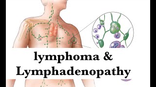 lymphoma amp lymphadenopathy pathology Hematologyamp Oncology Integrated lecture by ASM Minds Team [upl. by Anilet433]