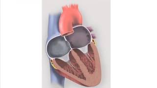 Patent Foramen Ovale PFO and Migraine [upl. by Ateuqahs]