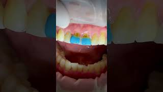 치경부마모 무삭제 세라믹피스 dental smile dentist dentistry dentalclinic abrasion [upl. by Dis332]