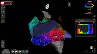 Atrial Flutter Case [upl. by Davidde]