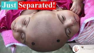 Conjoined Twins Rabia and Rukias Separation That Lasted 1 Full Year  Body Bizarre [upl. by Enilav]