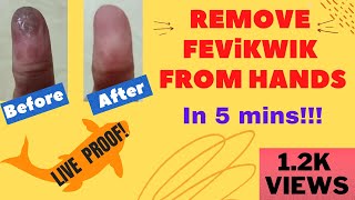 how to remove fevikwik from finger  feviquick hath se kaise nikale  Remove super glue from skin [upl. by Naoh]